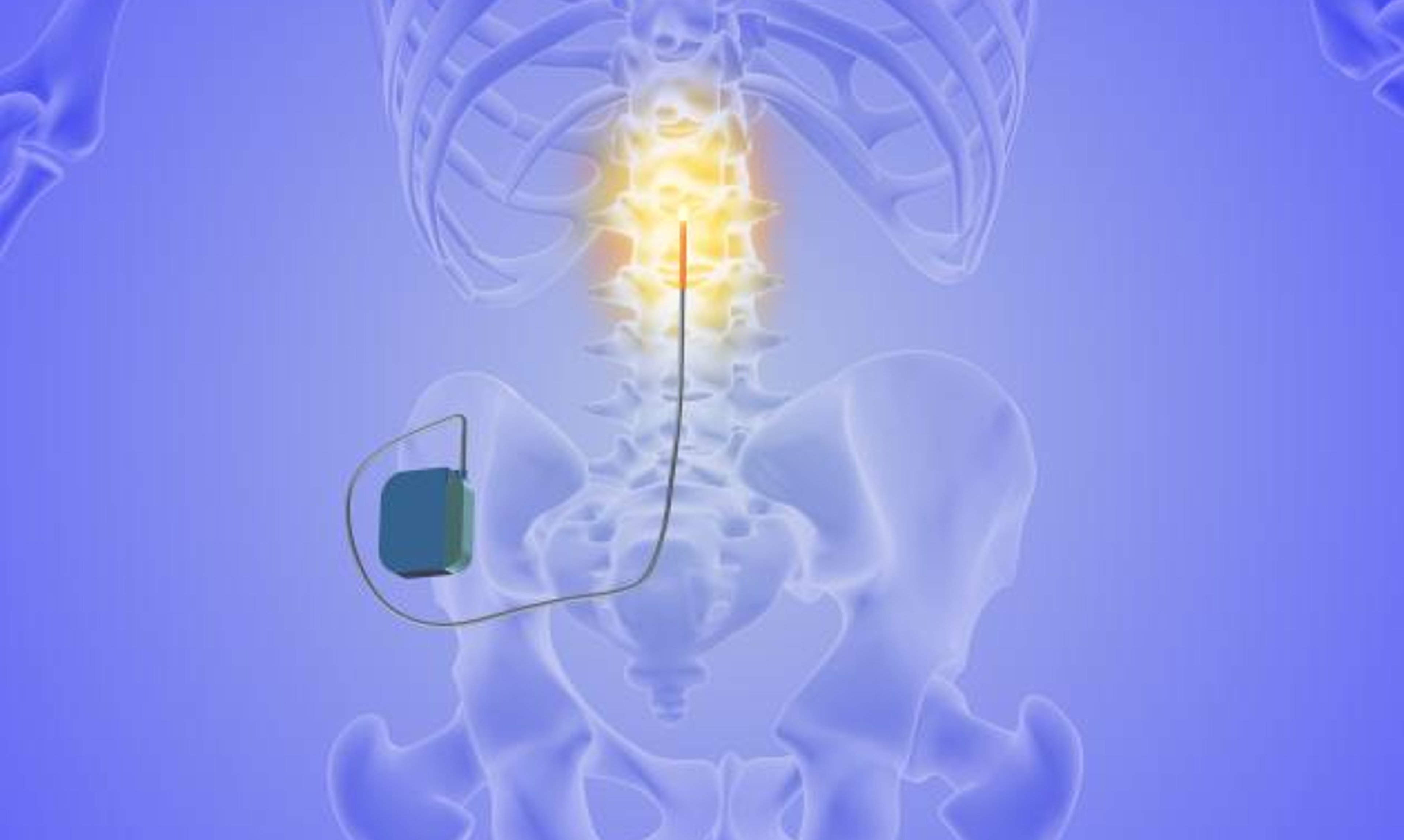 image of spinal cord stimulation device connection to spine on skeleton
