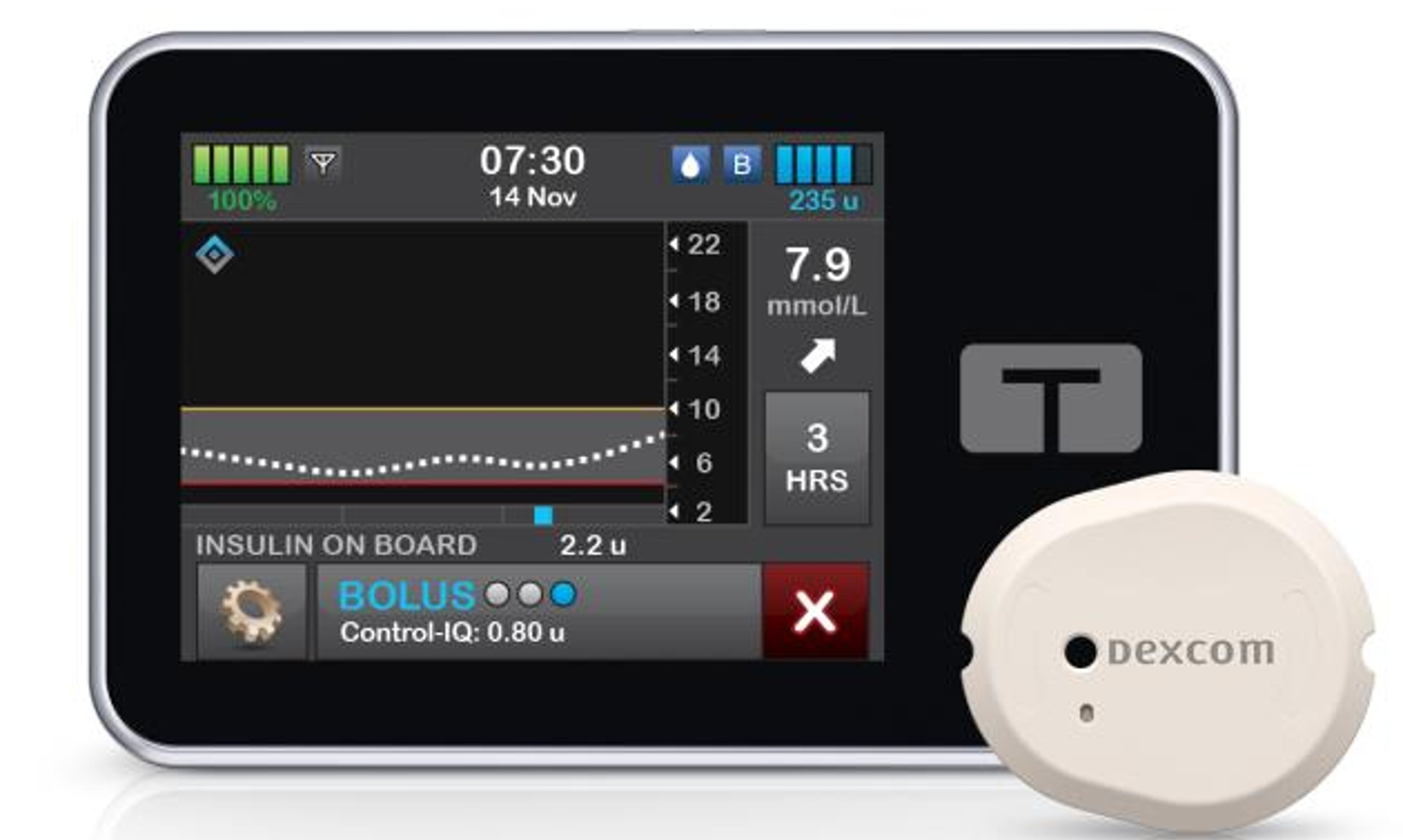 Tandem t:slim X2 and a Dexcom CGM sensor