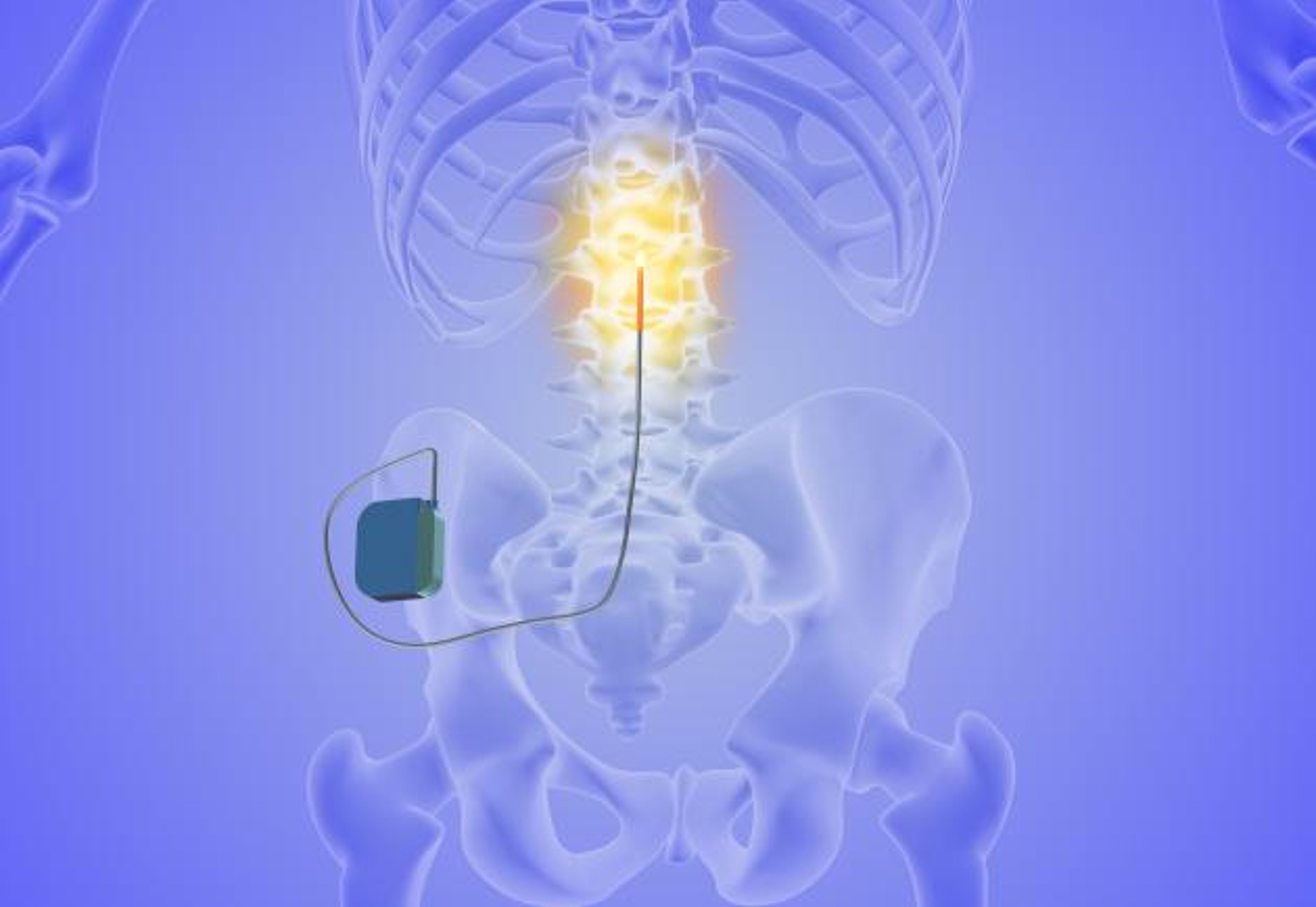 image of spinal cord stimulation device connection to spine on skeleton