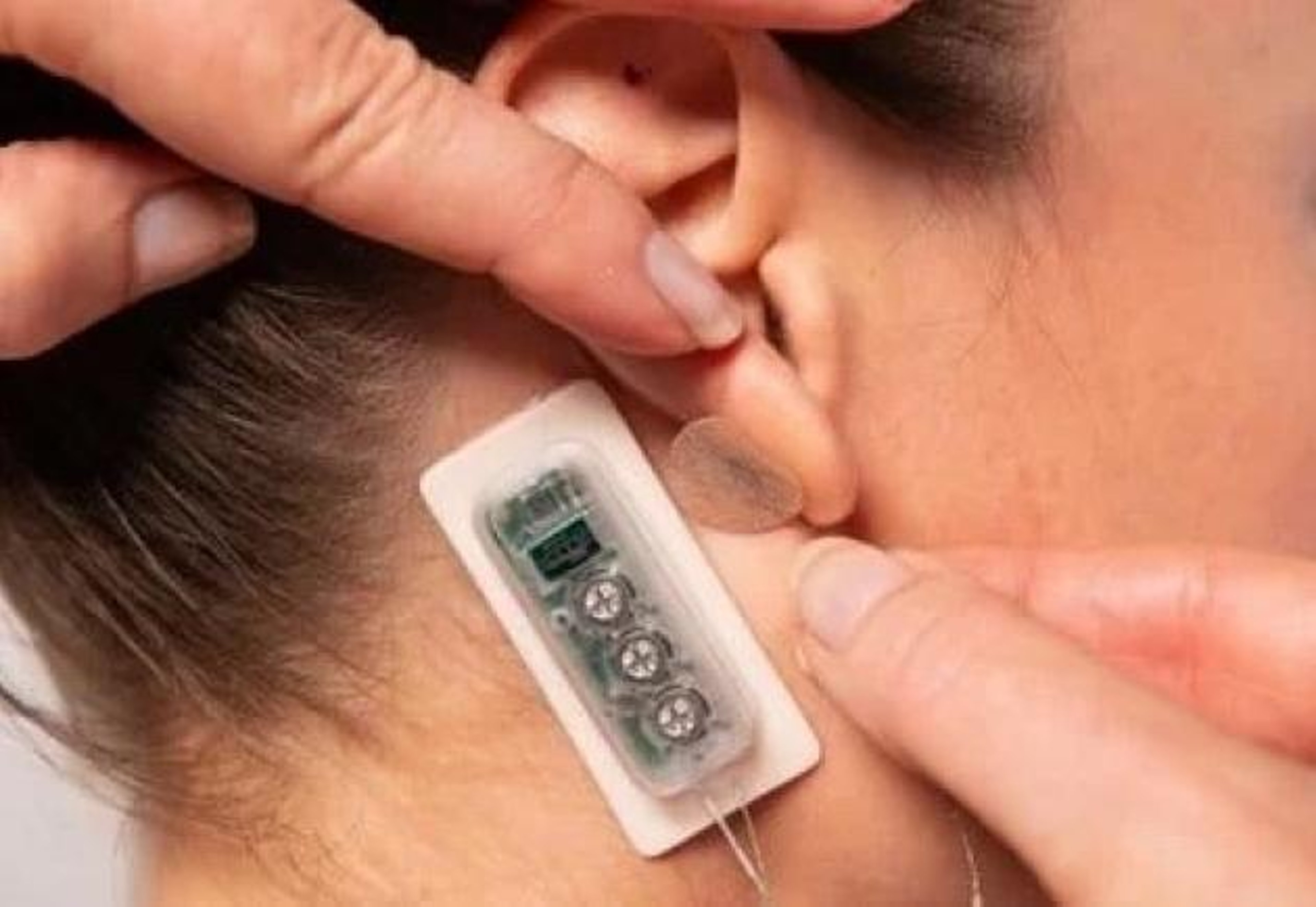 A percutaneous electrical nerve field stimulator behind the ear