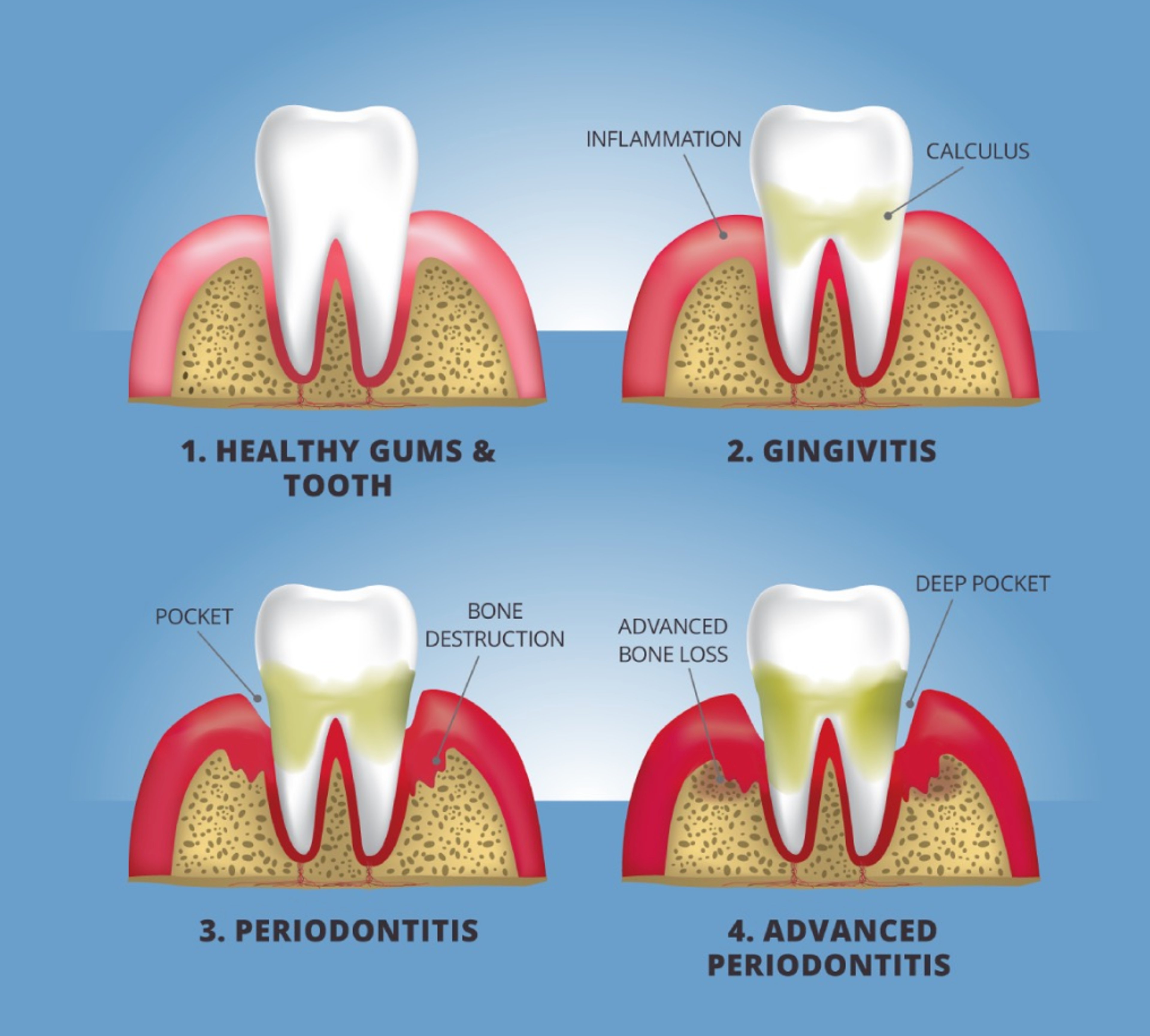 stages of gum disease