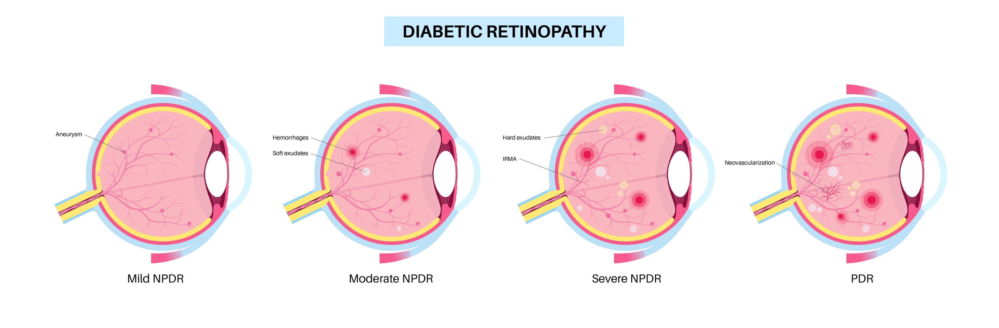 Illustration: 4 stages of diabetic retinopathy