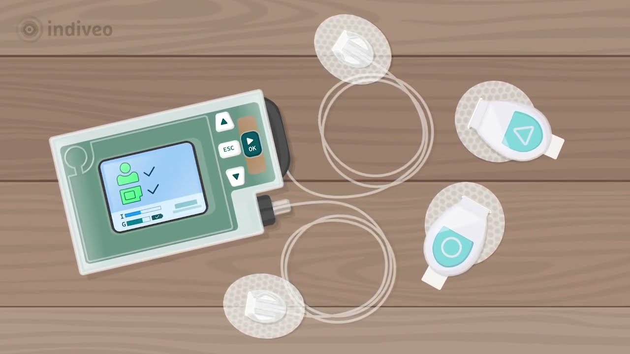 Inreda bihormonal artificial pancreas